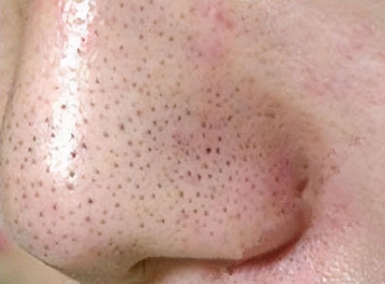 毛孔粗大黑頭多皮膚油應(yīng)該怎么辦_黑頭毛孔粗大油皮怎么辦_黑頭毛孔粗大油膩用什么產(chǎn)品好