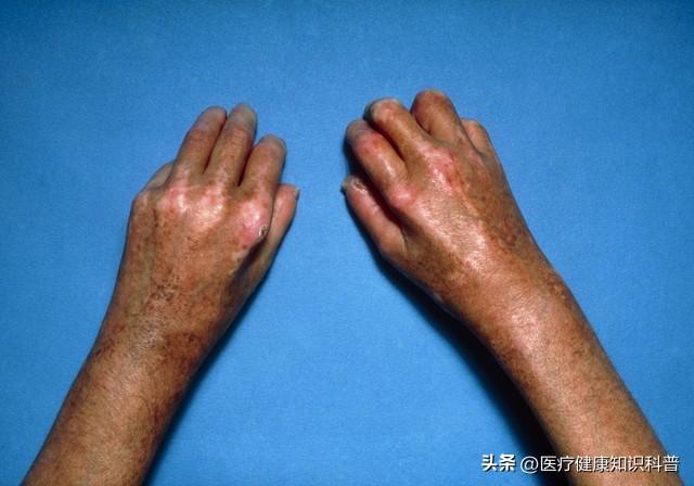 全身皮膚異常干燥_全身皮膚干燥是什么原因怎么解決_全身性皮膚干燥