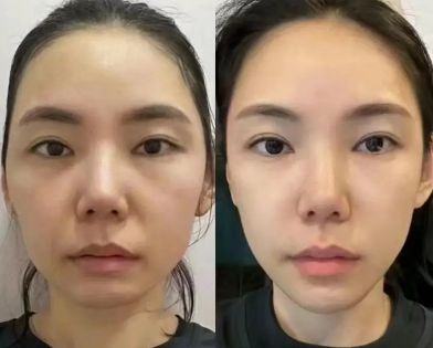 皺紋護膚品好去痘嗎_皺紋護膚品好去皺嗎_去皺紋的護膚品哪個好